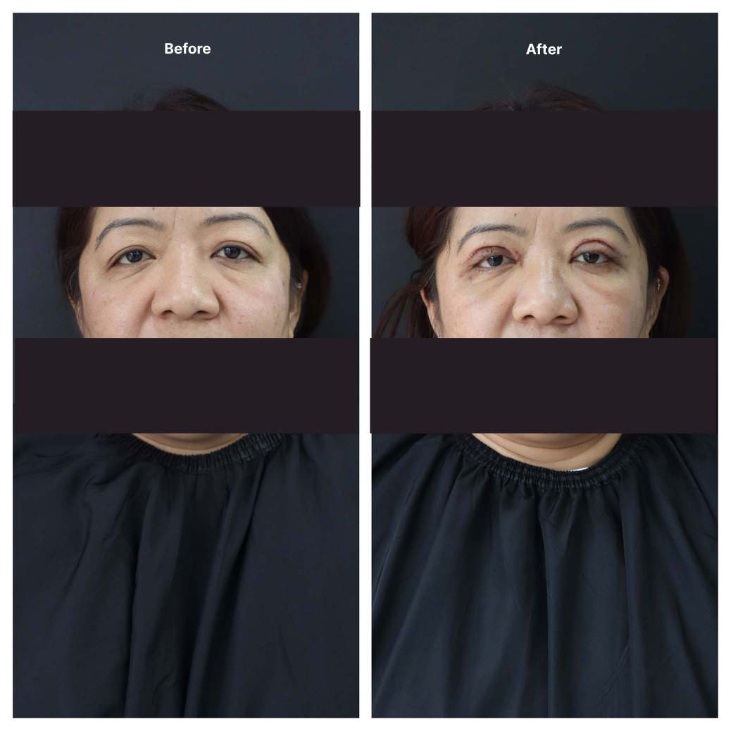 Eyelid Surgery KOQ10